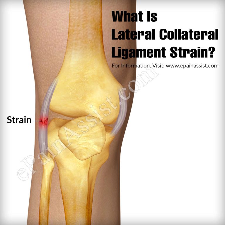 Lateral Collateral Ligament Strain: Causes, Symptoms, Treatment, Prognosis