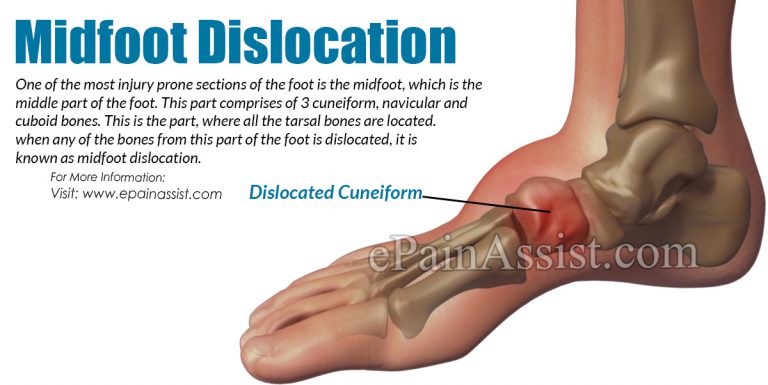 Midfoot Dislocation: Causes, Symptoms, Treatment, Home Remedies, Recovery Period
