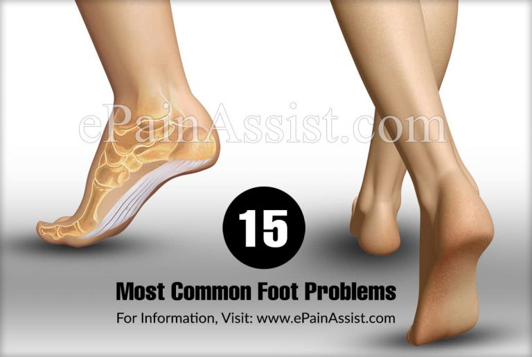 15 Most Common Foot Problems