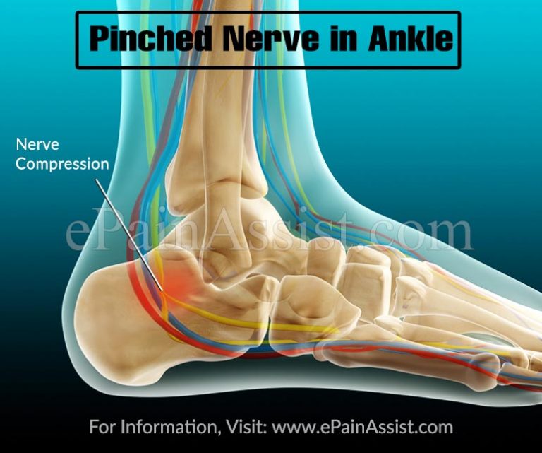 Pinched Nerve in Ankle: Causes, Symptoms, Treatment, Exercises
