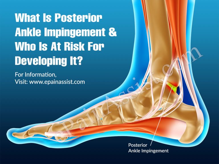 Posterior Ankle Impingement: Risks, Symptoms, Treatment