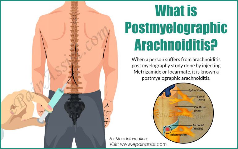 Postmyelographic Arachnoiditis: Causes, Symptoms, Treatment, Prognosis