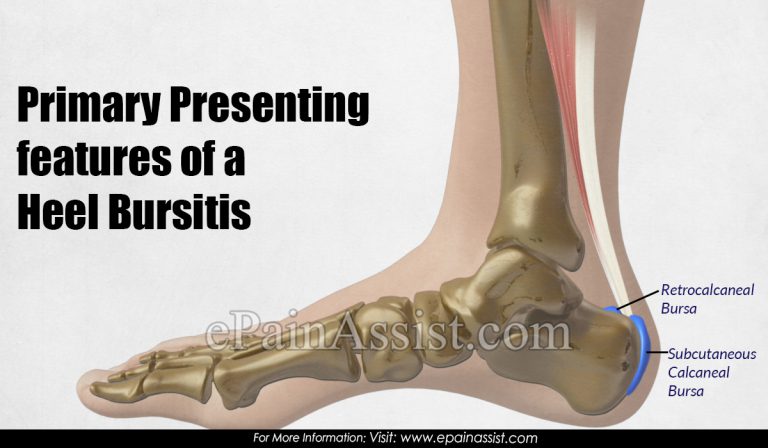 Primary Presenting Features of a Heel Bursitis