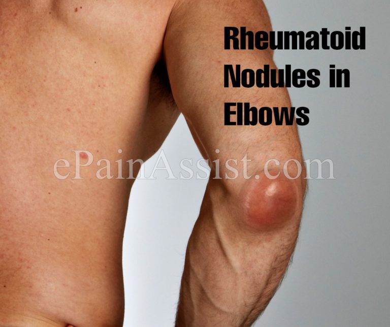 What Are Rheumatoid Nodules, Know its Causes, Treatment & Is it A Cause For Concern?
