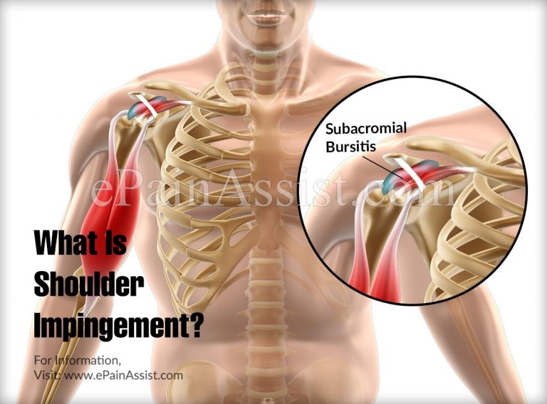 Shoulder Impingement: Causes, Symptoms, Treatment