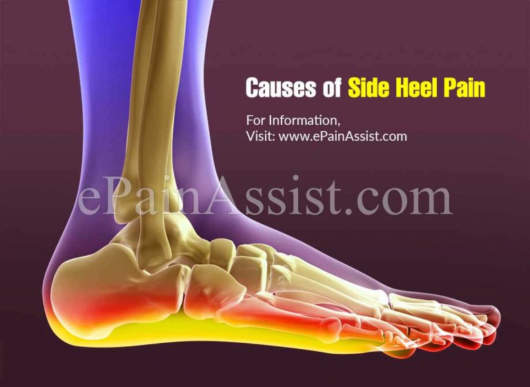 Side Heel Pain: Causes, Symptoms, Treatments, Diagnosis