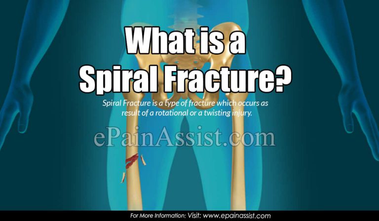 Spiral Fracture: Causes, Symptoms, Treatment, Healing Time