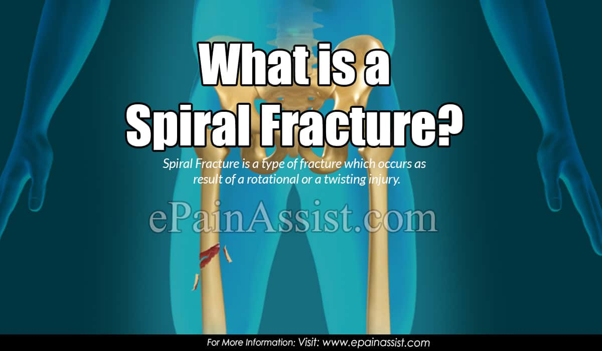 What is a Spiral Fracture?