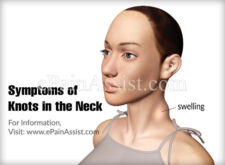 Knot in Neck: Causes, Symptoms, Treatment