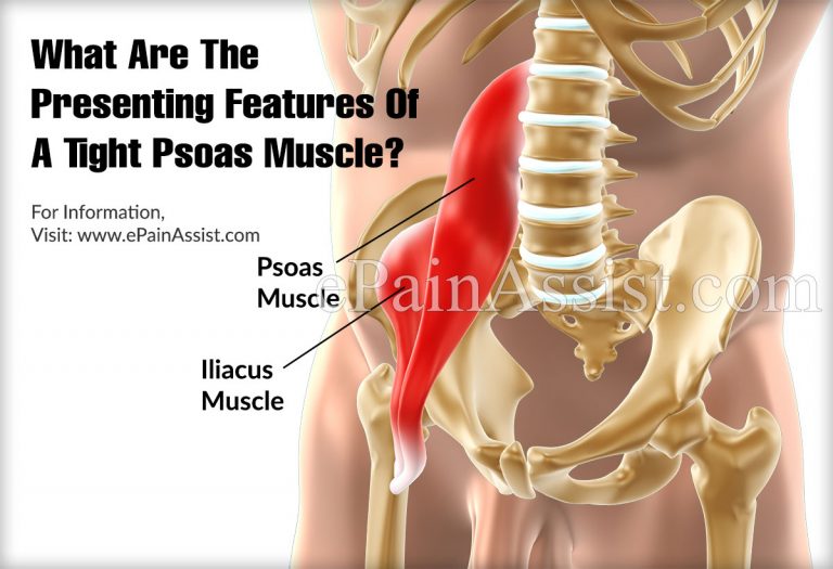 What Are The Presenting Features Of A Tight Psoas Muscle?