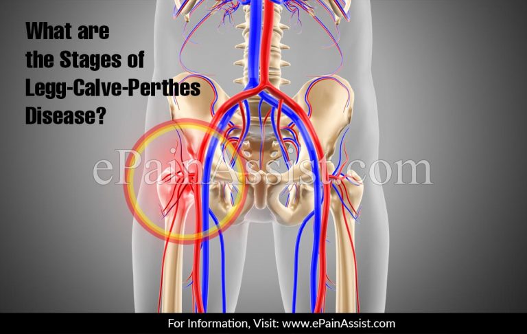 What Are The Stages Of Legg-Calve-Perthes Disease?