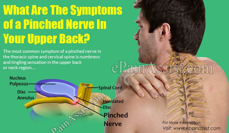 What Are The Symptoms of a Pinched Nerve In Your Upper Back?