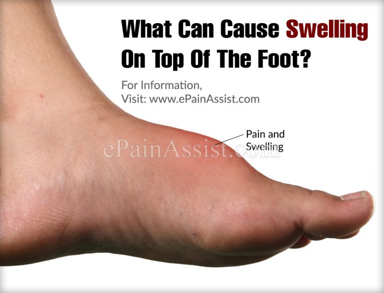 What Can Cause Swelling On Top Of The Foot?