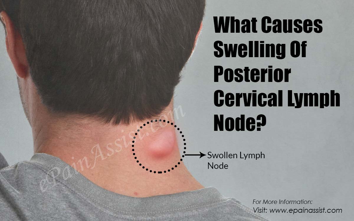 What Causes Swelling Of Posterior Cervical Lymph Node?