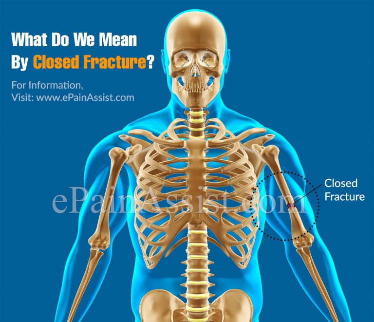 What Do We Mean By Closed Fracture & What is its Treatment, Recovery Period?