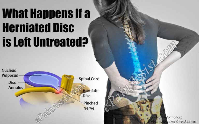 What Happens If a Herniated Disc is Left Untreated?