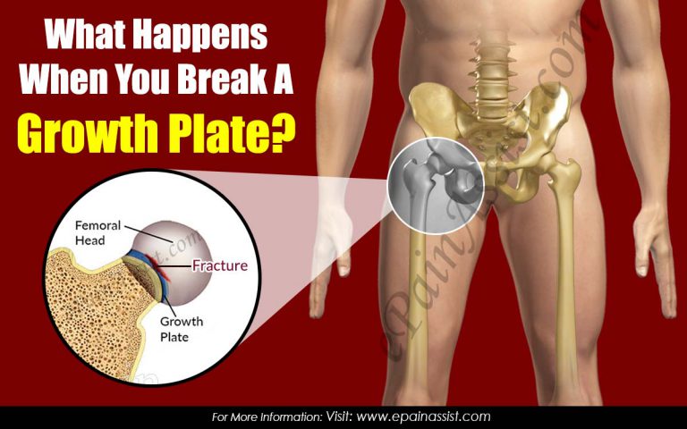 What Happens When You Break A Growth Plate?