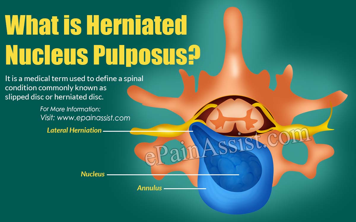 What is Herniated Nucleus Pulposus?