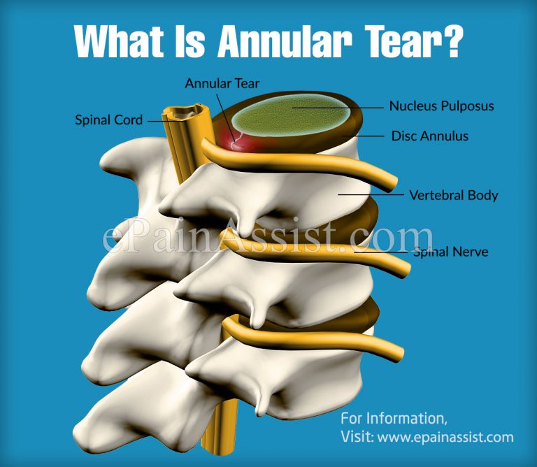 What Is Annular Tear & How Does It Feel Like?