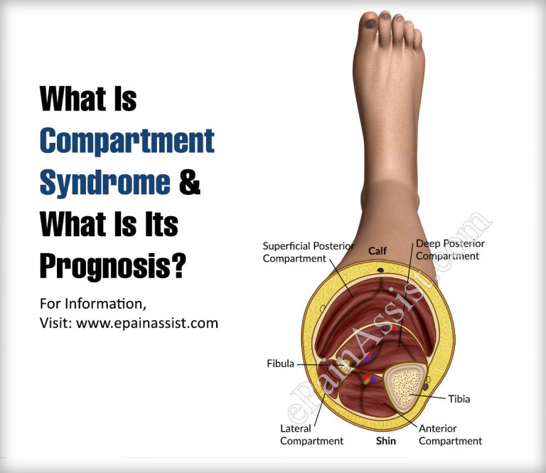 What Is Compartment Syndrome & What Is Its Prognosis?
