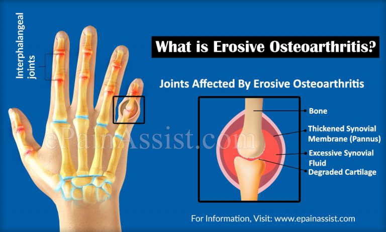 What is Erosive Osteoarthritis & How is it Treated?|Causes, Symptoms, Diagnosis of Erosive Osteoarthritis