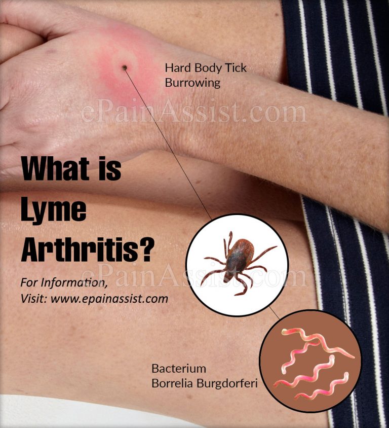 What Is Lyme Arthritis?