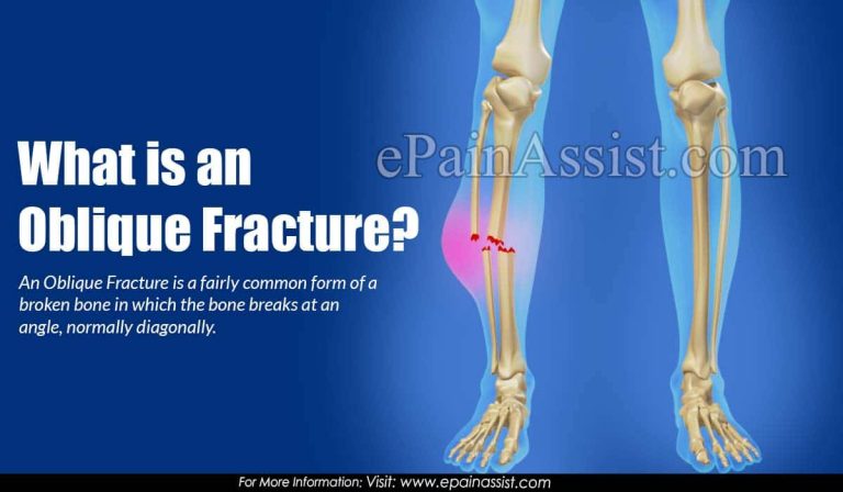 What is Oblique Fracture: Causes, Symptoms, Treatment, Healing Time