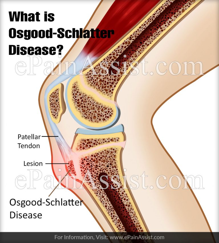 What is Osgood-Schlatter Disease, Know its Symptoms, Treatment