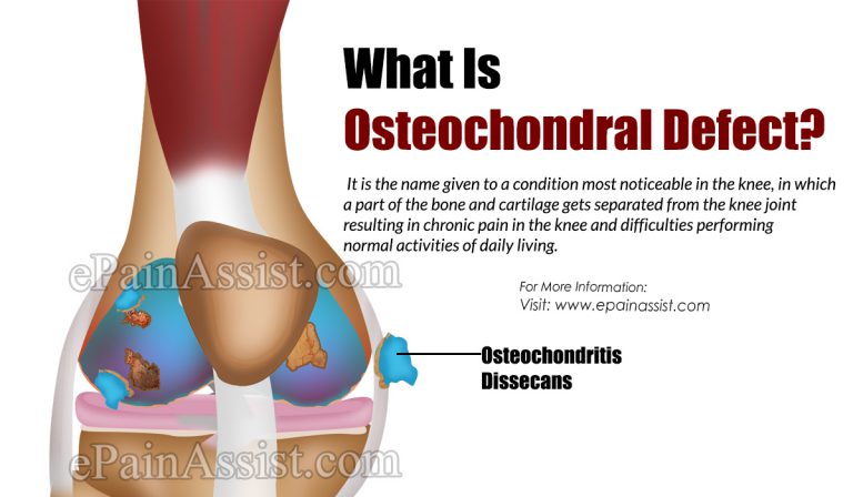 What is Osteochondral Defect: Causes, Symptoms, Treatment, Prevention