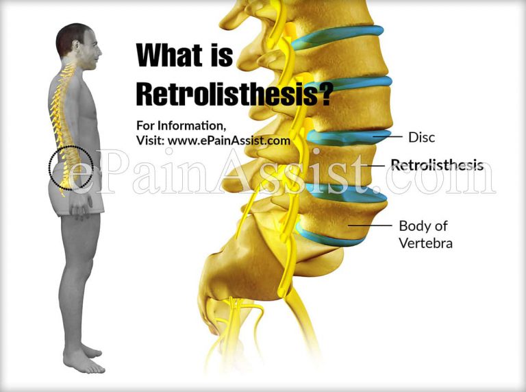 What is Retrolisthesis, Know its Types, Causes, Symptoms, Treatments, Prognosis
