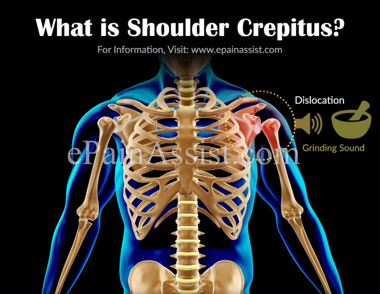 What is Shoulder Crepitus & Exercises to Get Rid of It?