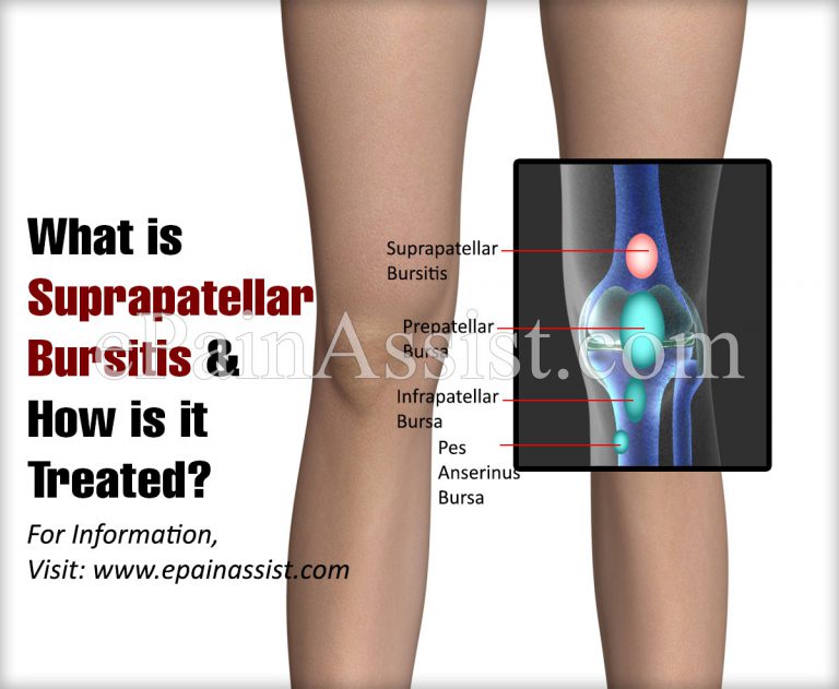 What is Suprapatellar Bursitis & How is it Treated?