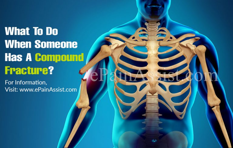 What To Do When Someone Has A Compound Fracture?