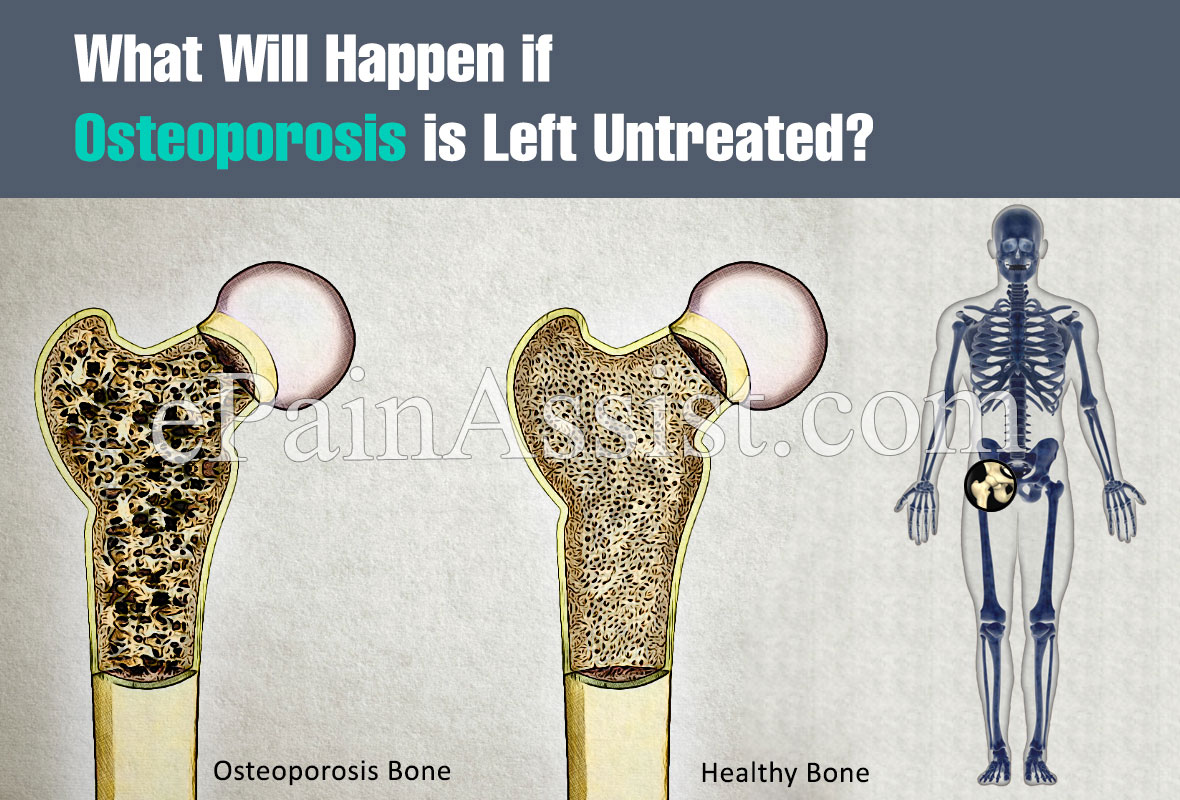 What Will Happen if Osteoporosis is Left Untreated?