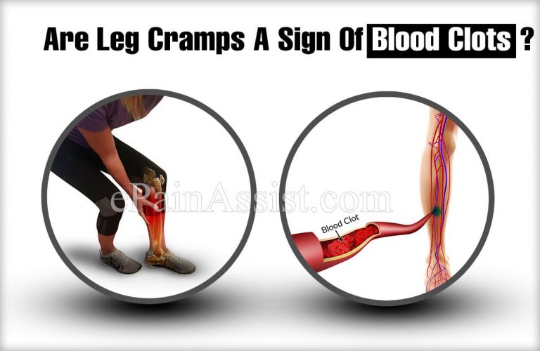 Are Leg Cramps A Sign Of Blood Clots?