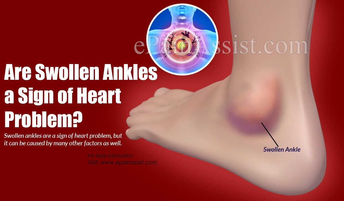 Are Swollen Ankles a Sign of Heart Problem?