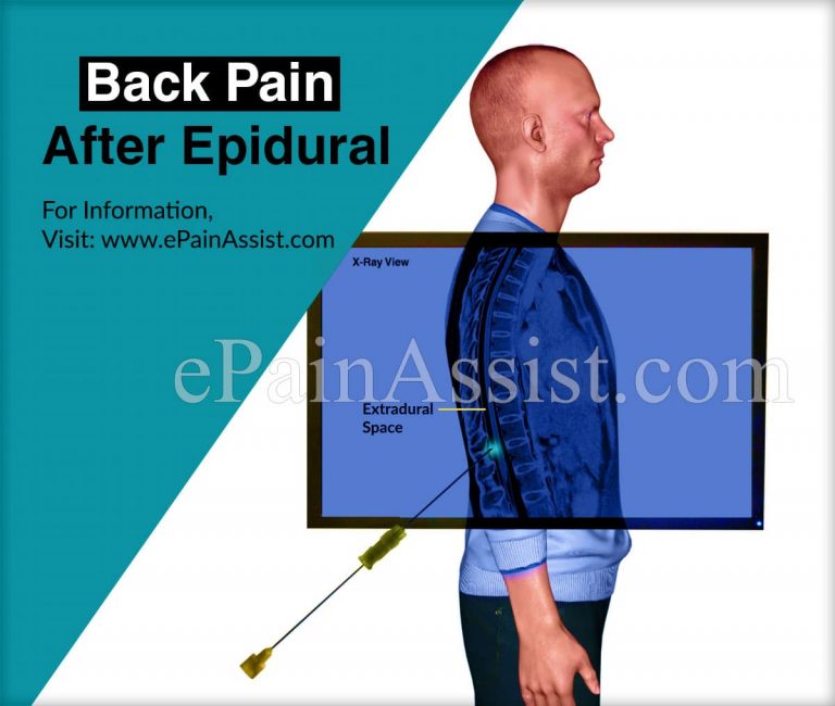 Back Pain After Epidural