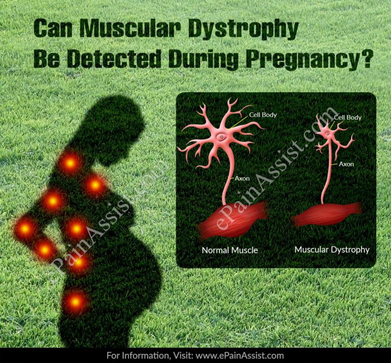 Can Muscular Dystrophy Be Detected During Pregnancy?