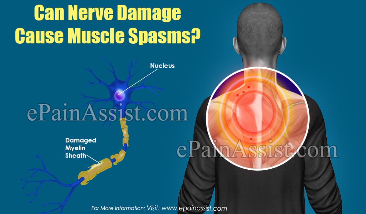 Can Nerve Damage Cause Muscle Spasms?