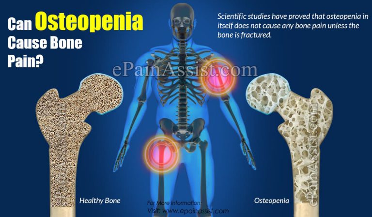 Can Osteopenia Cause Bone Pain?