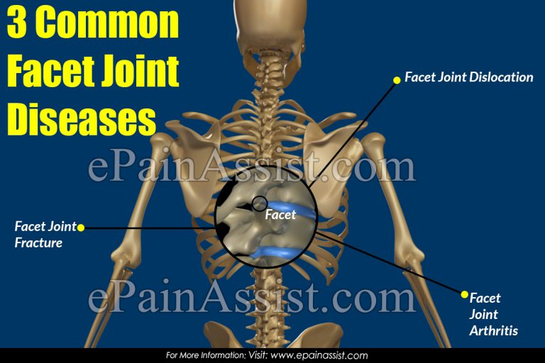 3 Common Facet Joint Diseases|Signs, Symptoms, Diagnosis of  Facet Joint Diseases