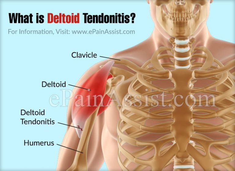 Deltoid Tendonitis: Causes, Symptoms, Treatment, Exercises