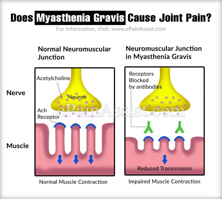 Does Myasthenia Gravis Cause Joint Pain?