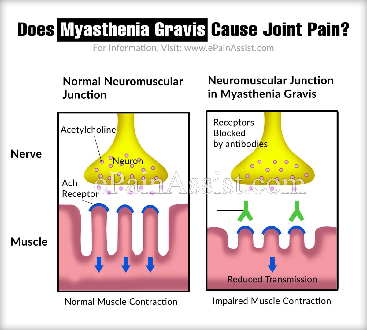 Does Myasthenia Gravis Cause Joint Pain?