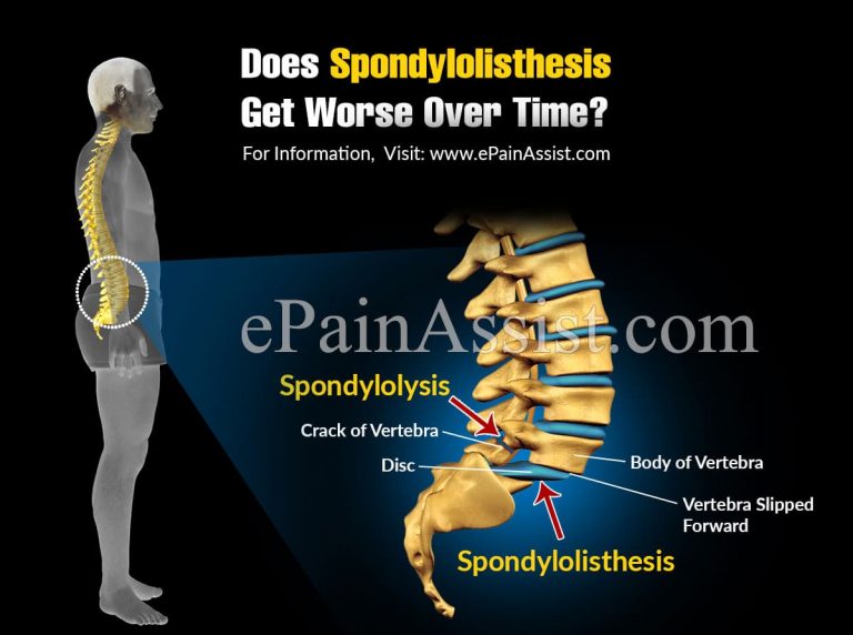 Does Spondylolisthesis Get Worse Over Time & Can It Cause Paralysis?