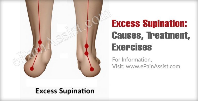 Excess Supination: Causes, Treatment, Exercises