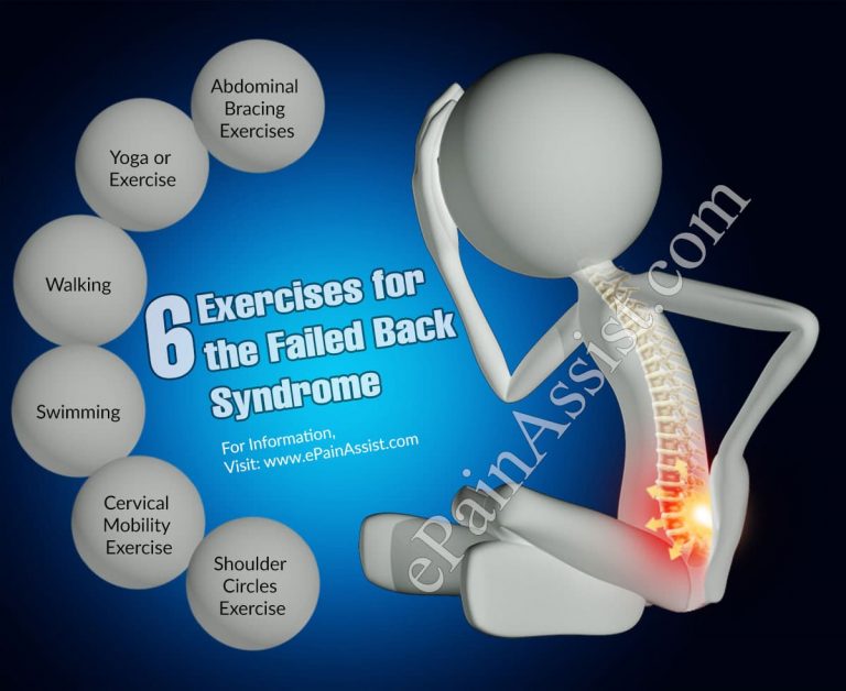 6 Exercises for the Failed Back Syndrome