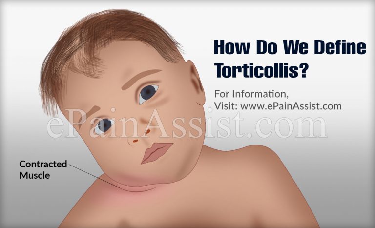 Torticollis or Wry Neck or Loxia: Causes, Symptoms, Diagnosis, Treatment, Prognosis