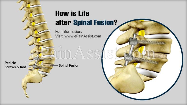 How Is Life After Spinal Fusion?