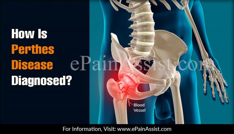 How Is Perthes Disease Diagnosed?